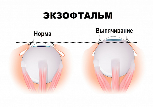 Экзофтальм